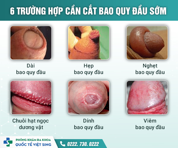https://khambenhnamkhoa.com/wp-content/uploads/2023/05/6-trường-hợp-cắt-bao-quy-đầu-sớm.jpg