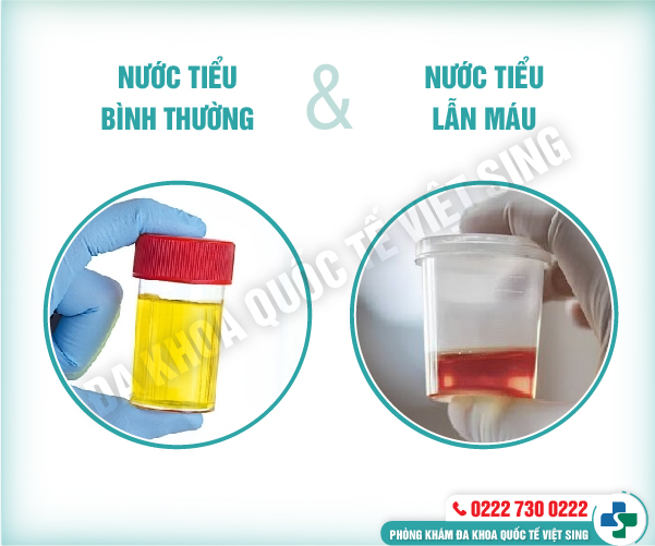 Tiểu ra máu có nguy hiểm không? Liệu có gây ung thư?