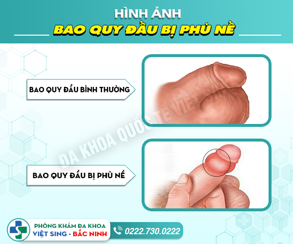 Nam giới bị phù nề bao quy đầu phải làm sao?