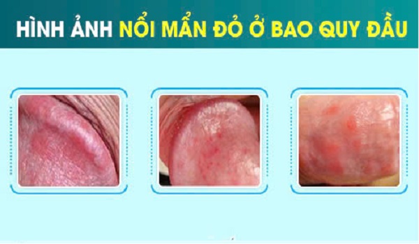 Bao quy đầu mẩn đỏ là dấu hiệu bệnh gì? 5 Nguyên nhân nam giới không nên chủ quan